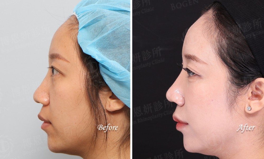 韓式隆鼻,結構式隆鼻,縮鼻翼手術,博恩妍